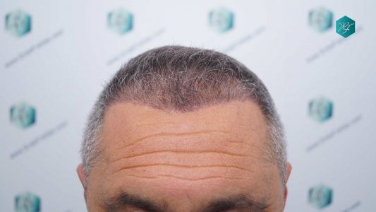 RESULTADOS 3 MESES 31 EVOLUCION A LOS 3 MESES