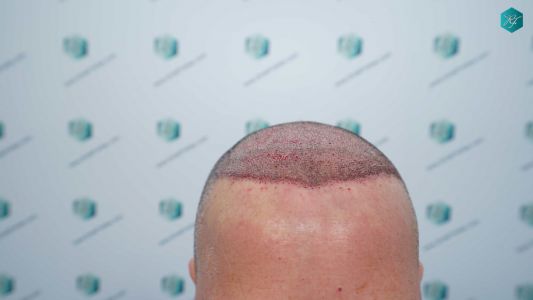 Injerto Capilar Técnica FUE Grafts 3289 (8464 Pelos) 17 31 TRASPLANTE CAPILAR