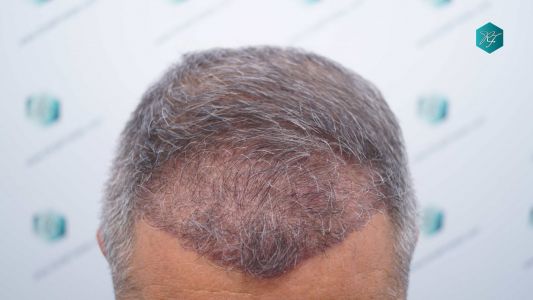 Injerto Capilar Técnica FUE Grafts 3712 (7455 Pelos) 27 32 EVOLUCION A LOS 3 MESES