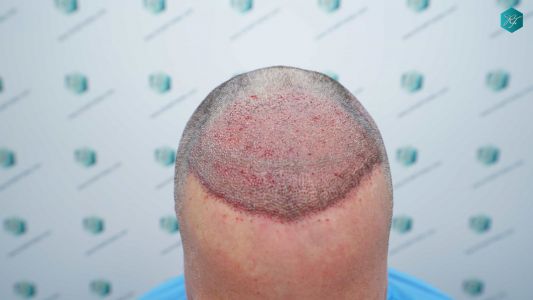 Injerto Capilar Técnica FUE Grafts 3289 (8464 Pelos) 18 32 TRASPLANTE CAPILAR