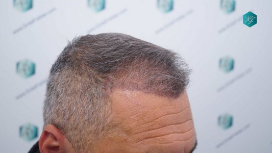 Injerto Capilar Técnica FUE Grafts 3712 (7455 Pelos) 28 34 EVOLUCION A LOS 3 MESES