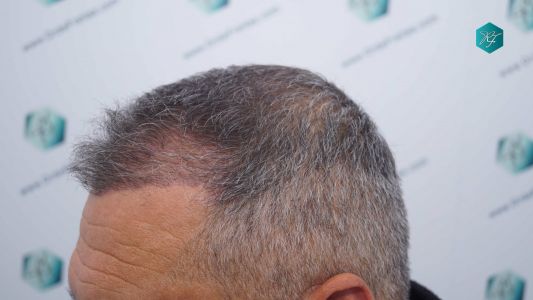Injerto Capilar Técnica FUE Grafts 3712 (7455 Pelos) 29 34A EVOLUCION A LOS 3 MESES