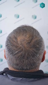 Injerto Capilar Técnica FUE Grafts 3712 (7455 Pelos) 31 35 EVOLUCION A LOS 3 MESES