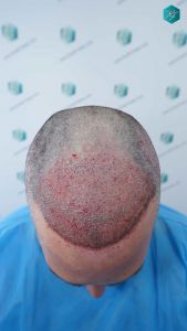 Injerto Capilar Técnica FUE Grafts 3289 (8464 Pelos) 20 35 TRASPLANTE CAPILAR