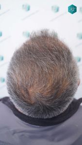 Injerto Capilar Técnica FUE Grafts 3712 (7455 Pelos) 32 36 EVOLUCION A LOS 3 MESES