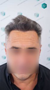 RESULTADOS A LOS 12 MESES 37 EVOLUCION A LOS 12 MESES