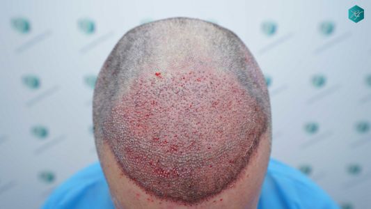 Injerto Capilar Técnica FUE Grafts 3289 (8464 Pelos) 21 37 TRASPLANTE CAPILAR