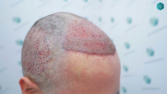Injerto Capilar Técnica FUE Grafts 3289 (8464 Pelos) 22 37B TRASPLANTE CAPILAR