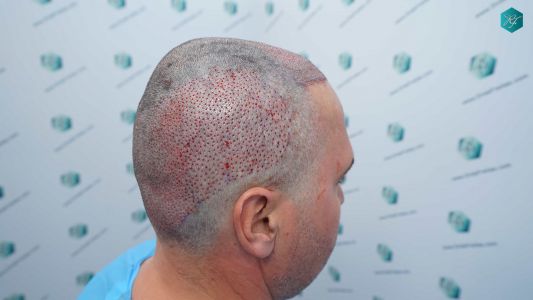 Injerto Capilar Técnica FUE Grafts 3289 (8464 Pelos) 23 37C TRASPLANTE CAPILAR