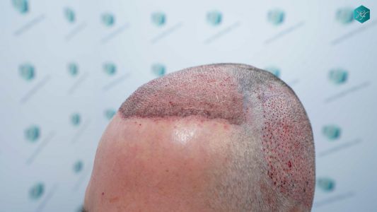 Injerto Capilar Técnica FUE Grafts 3289 (8464 Pelos) 24 37D TRASPLANTE CAPILAR