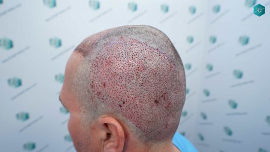 Injerto Capilar Técnica FUE Grafts 3289 (8464 Pelos) 25 37E TRASPLANTE CAPILAR