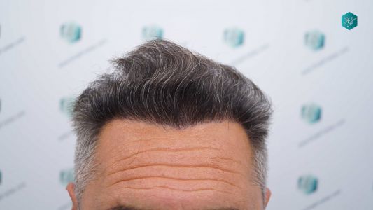 Injerto Capilar Técnica FUE Grafts 3712 (7455 Pelos) 33 38 EVOLUCION A LOS 12 MESES