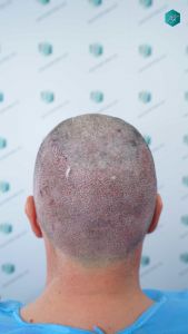 Injerto Capilar Técnica FUE Grafts 3289 (8464 Pelos) 26 38 TRASPLANTE CAPILAR