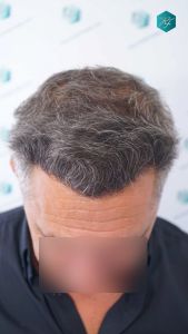 Injerto Capilar Técnica FUE Grafts 3712 (7455 Pelos) 34 38A EVOLUCION A LOS 12 MESES