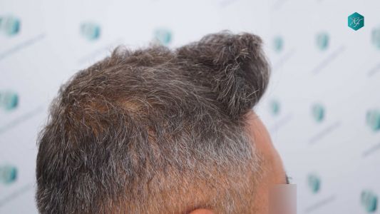 Injerto Capilar Técnica FUE Grafts 3712 (7455 Pelos) 35 38B EVOLUCION A LOS 12 MESES