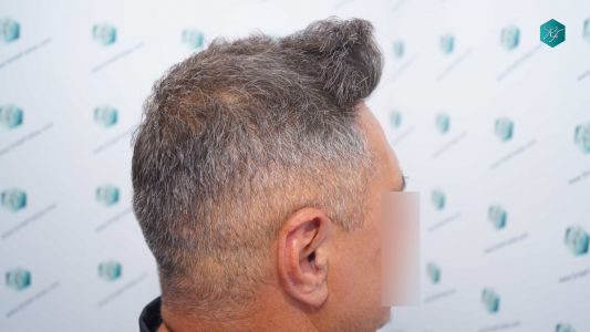 Injerto Capilar Técnica FUE Grafts 3712 (7455 Pelos) 36 38BB EVOLUCION A LOS 12 MESES