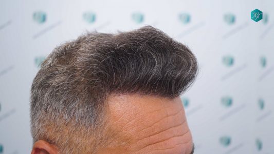 Injerto Capilar Técnica FUE Grafts 3712 (7455 Pelos) 37 38BC EVOLUCION A LOS 12 MESES