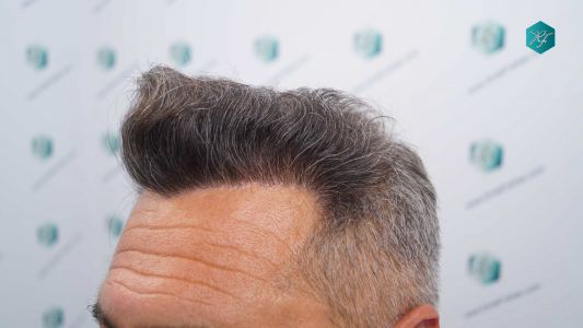 Injerto Capilar Técnica FUE Grafts 3712 (7455 Pelos) 38 39 EVOLUCION A LOS 12 MESES