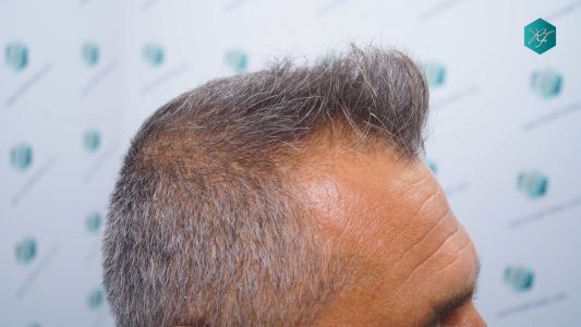 Injerto Capilar Técnica FUE Grafts 3712 (7455 Pelos) 3 3A ANTES DEL TRASPLANTE CAPILAR