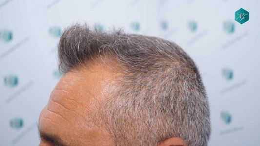 Injerto Capilar Técnica FUE Grafts 3712 (7455 Pelos) 4 3B ANTES DEL TRASPLANTE CAPILAR