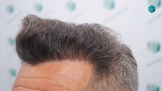 Injerto Capilar Técnica FUE Grafts 3712 (7455 Pelos) 39 40 EVOLUCION A LOS 12 MESES