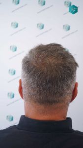 Injerto Capilar Técnica FUE Grafts 3712 (7455 Pelos) 40 42 EVOLUCION A LOS 12 MESES