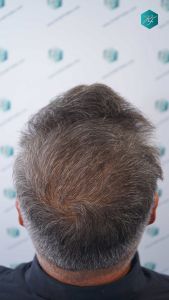 Injerto Capilar Técnica FUE Grafts 3712 (7455 Pelos) 41 47 EVOLUCION A LOS 12 MESES