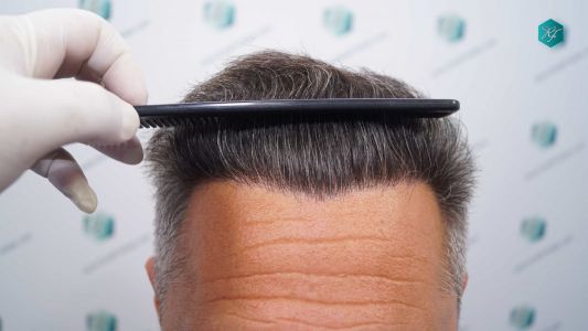 Injerto Capilar Técnica FUE Grafts 3712 (7455 Pelos) 42 49 EVOLUCION A LOS 12 MESES