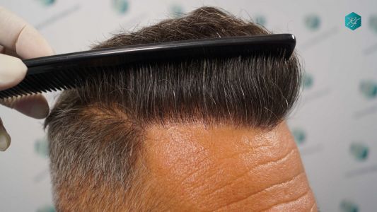 Injerto Capilar Técnica FUE Grafts 3712 (7455 Pelos) 43 49A EVOLUCION A LOS 12 MESES