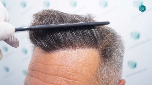 Injerto Capilar Técnica FUE Grafts 3712 (7455 Pelos) 44 49B EVOLUCION A LOS 12 MESES