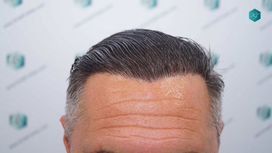 Injerto Capilar Técnica FUE Grafts 3712 (7455 Pelos) 45 51 EVOLUCION A LOS 12 MESES