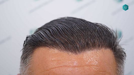 Injerto Capilar Técnica FUE Grafts 3712 (7455 Pelos) 46 51A EVOLUCION A LOS 12 MESES