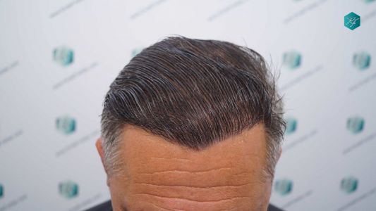 Injerto Capilar Técnica FUE Grafts 3712 (7455 Pelos) 47 51AB EVOLUCION A LOS 12 MESES