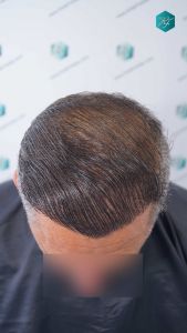 Injerto Capilar Técnica FUE Grafts 3712 (7455 Pelos) 48 51B EVOLUCION A LOS 12 MESES