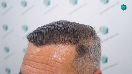 Injerto Capilar Técnica FUE Grafts 3712 (7455 Pelos) 50 53B EVOLUCION A LOS 12 MESES