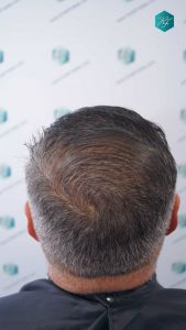 Injerto Capilar Técnica FUE Grafts 3712 (7455 Pelos) 51 57 EVOLUCION A LOS 3 MESES