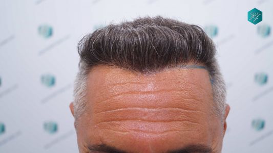 Injerto Capilar Técnica FUE Grafts 3712 (7455 Pelos) 52 59 DISENO LINEA INJERTO