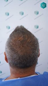 Injerto Capilar Técnica FUE Grafts 3712 (7455 Pelos) 5 6 ANTES DEL TRASPLANTE CAPILAR 1
