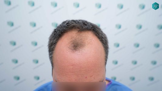 Injerto Capilar Técnica FUE Grafts 3289 (8464 Pelos) 3 6 ANTES DEL TRASPLANTE CAPILAR