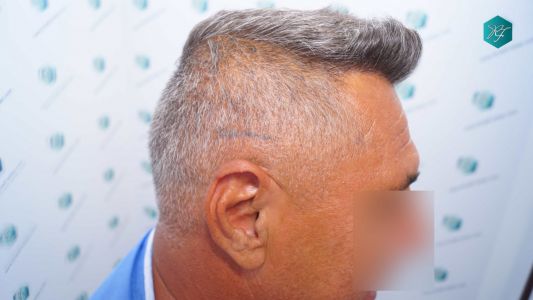 Injerto Capilar Técnica FUE Grafts 3712 (7455 Pelos) 53 60A DISENO LINEA INJERTO