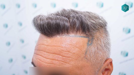 Injerto Capilar Técnica FUE Grafts 3712 (7455 Pelos) 54 60AB DISENO LINEA INJERTO