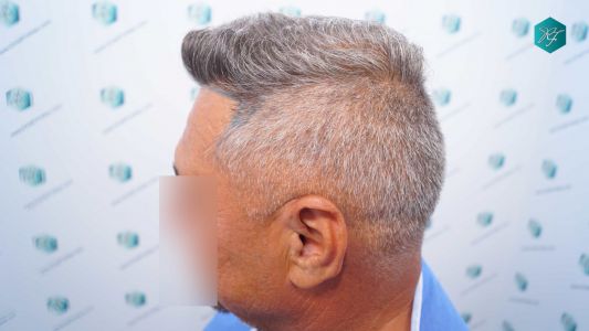 Injerto Capilar Técnica FUE Grafts 3712 (7455 Pelos) 55 62 DISENO LINEA INJERTO