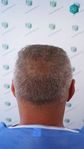 Injerto Capilar Técnica FUE Grafts 3712 (7455 Pelos) 56 63 DISENO LINEA INJERTO