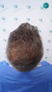 Injerto Capilar Técnica FUE Grafts 3712 (7455 Pelos) 57 64 DISENO LINEA INJERTO