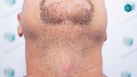 Injerto Capilar Técnica FUE Grafts 3712 (7455 Pelos) 58 65 DISENO LINEA INJERTO
