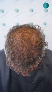 Injerto Capilar Técnica FUE Grafts 3712 (7455 Pelos) 59 66 DISENO LINEA INJERTO