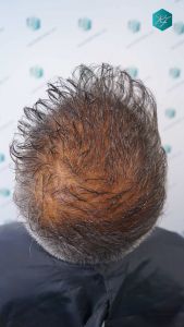 Injerto Capilar Técnica FUE Grafts 3712 (7455 Pelos) 60 67 DISENO LINEA INJERTO