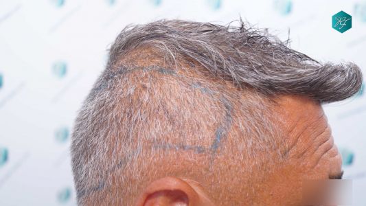 Injerto Capilar Técnica FUE Grafts 3712 (7455 Pelos) 61 68 DISENO LINEA INJERTO
