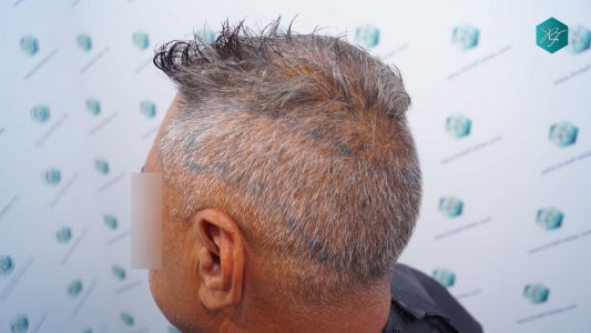 Injerto Capilar Técnica FUE Grafts 3712 (7455 Pelos) 62 68A DISENO LINEA INJERTO