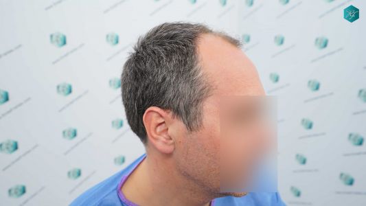 Injerto Capilar Técnica FUE Grafts 3289 (8464 Pelos) 4 6A ANTES DEL TRASPLANTE CAPILAR